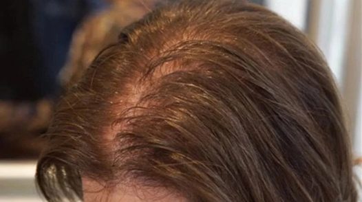 Rụng tóc nhiều sau tuổi 40, phụ nữ nên làm gì để lấy lại mái tóc dày khỏe?