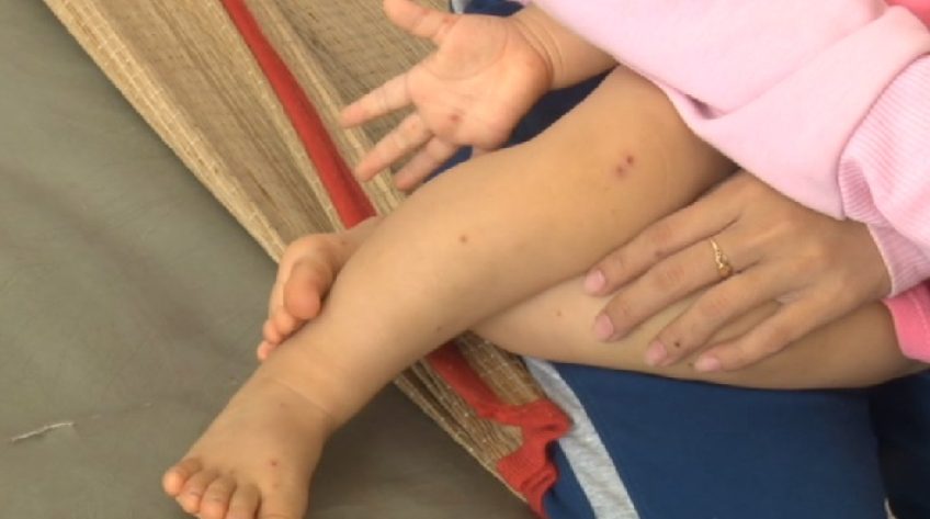 Phân biệt bệnh thủy đậu và tay chân miệng