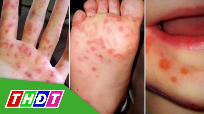 Bệnh tay chân miệng đang gia tăng rất nhanh