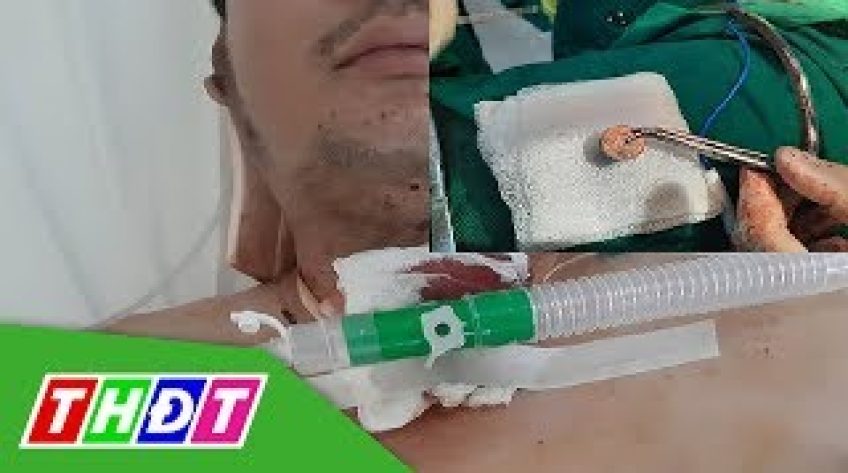 Mở khí quản cấp cứu người đàn ông nuốt đồng xu