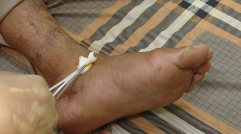 Cảnh báo gia tăng các trường hợp bị rắn cắn