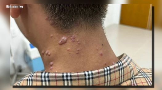 Chưa xác định được nguồn lây ca đậu mùa khỉ ở Đồng Nai