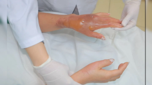 Bồn cầu phát nổ sau khi đổ hóa chất, người phụ nữ bỏng nặng