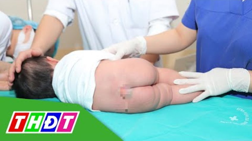 Bé gái 5 tháng tuổi có đuôi vùng xương cụt dài gần 10 cm